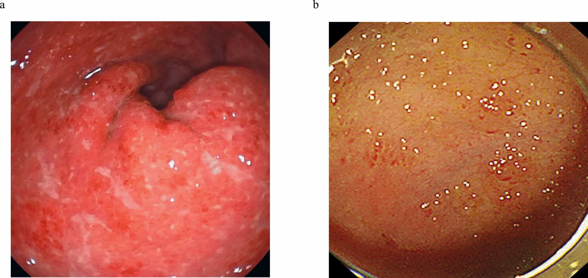 Severe luminal stricture in immune-related adverse event-associated enteritis: a case report