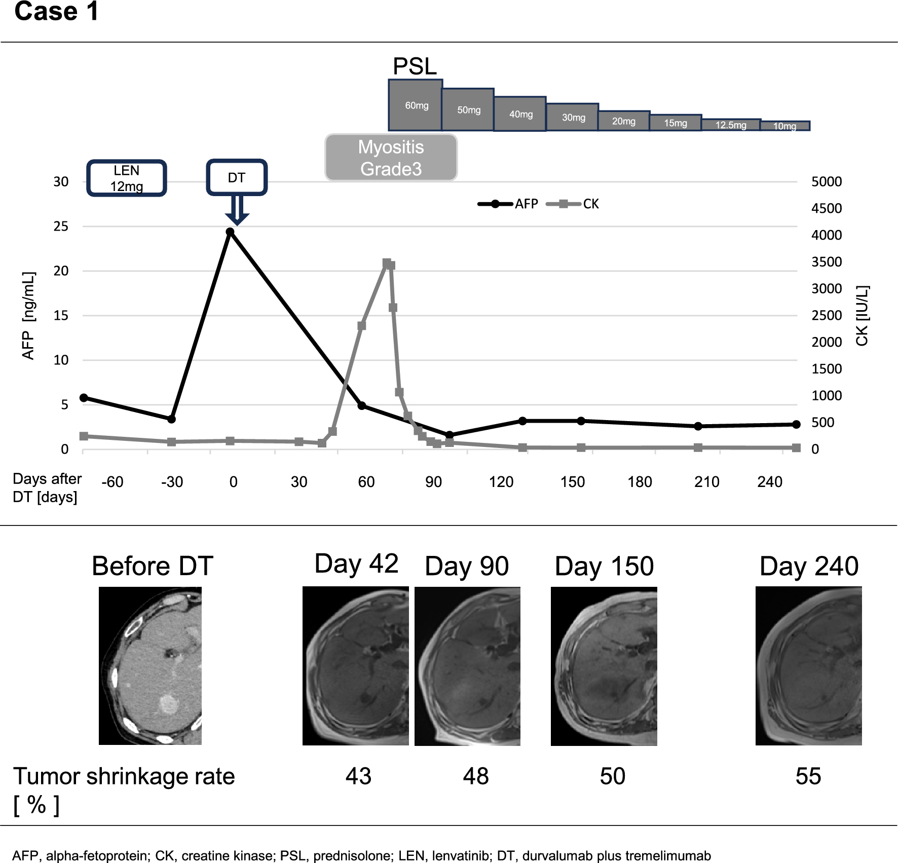 Immune-related adverse events in patients with low baseline serum IL-6 treated with durvalumab plus tremelimumab for hepatocellular carcinoma: a case series