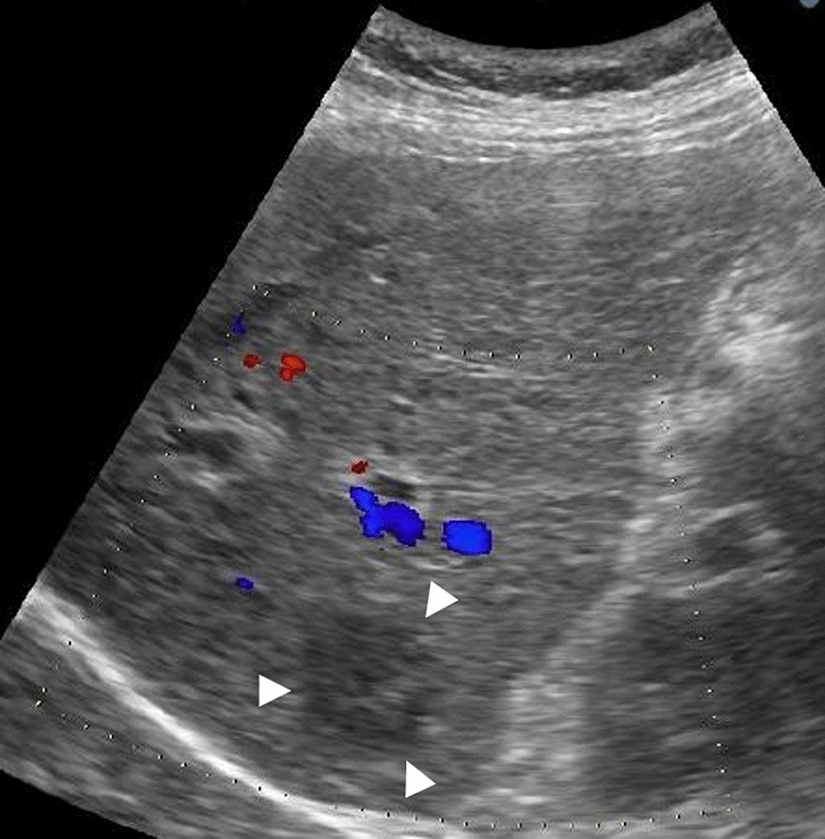 First report of metabolic complete response in hepatic sarcomatoid carcinoma achieved with carbon-ion radiotherapy