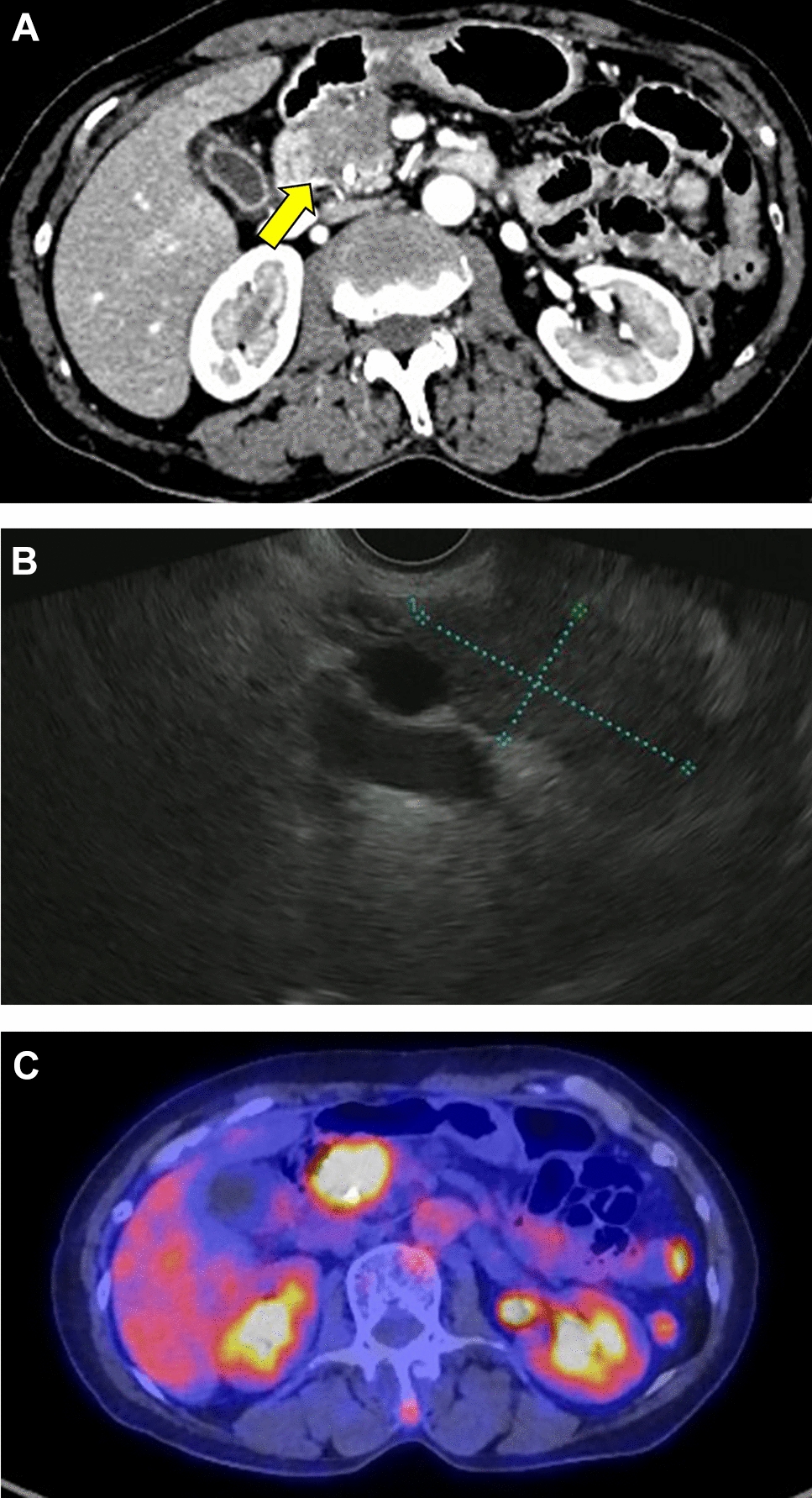 Successful conversion surgery for patients with pancreatic cancer, positive peritoneal cytology, and liver metastasis who were treated with chemotherapy involving nanoliposomal irinotecan with fluorouracil and folinic acid