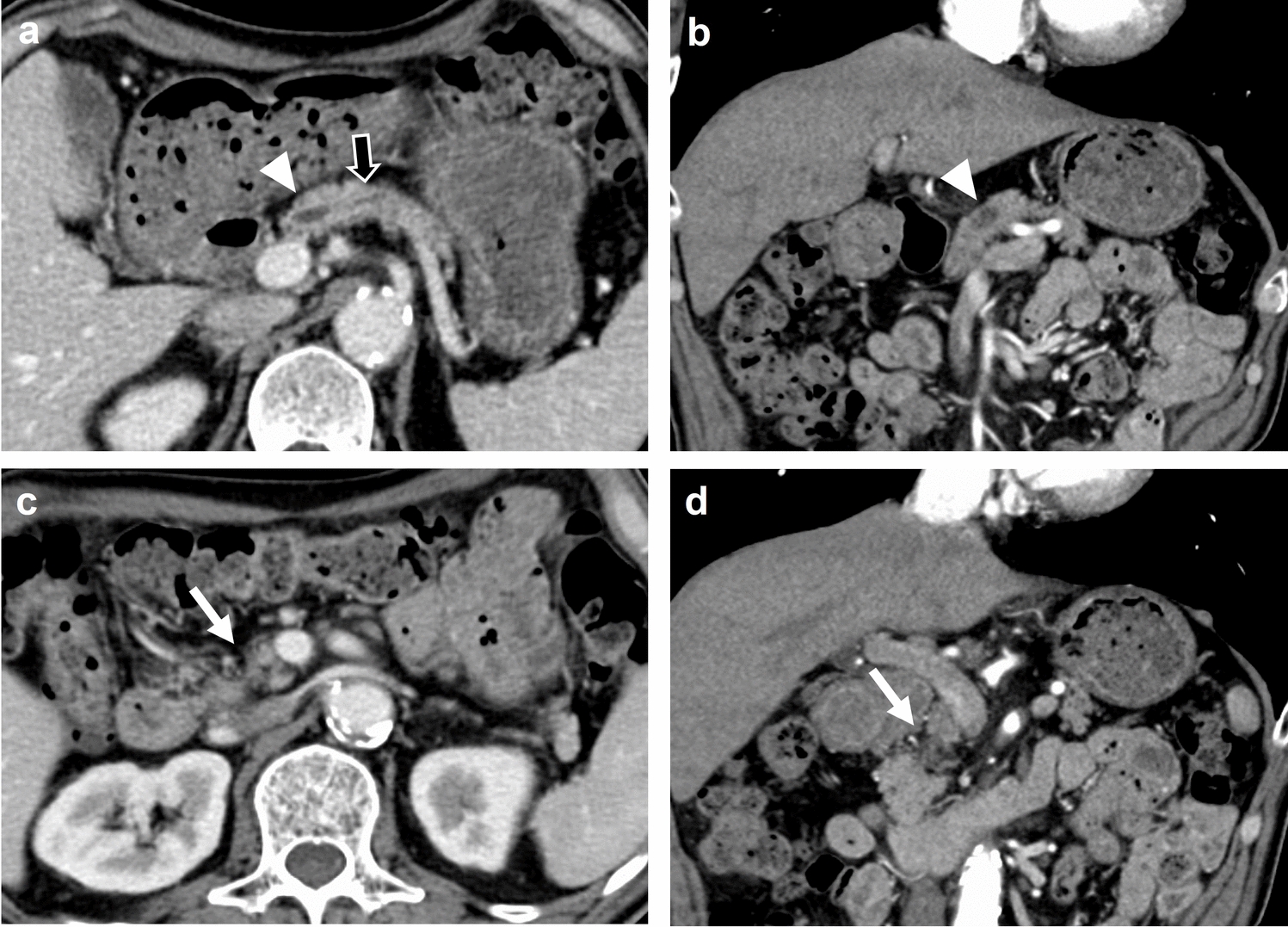 A case of extensive intraepithelial lesions throughout the pancreas with focal high-grade pancreatic intraepithelial neoplasm: implications for diagnosis and surgical strategy