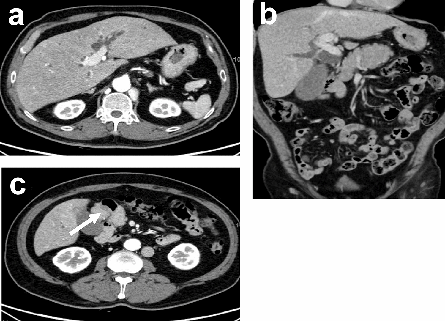 A case of distal bile duct cancer in a patient with polysplenia syndrome and ventral pancreatic malrotation