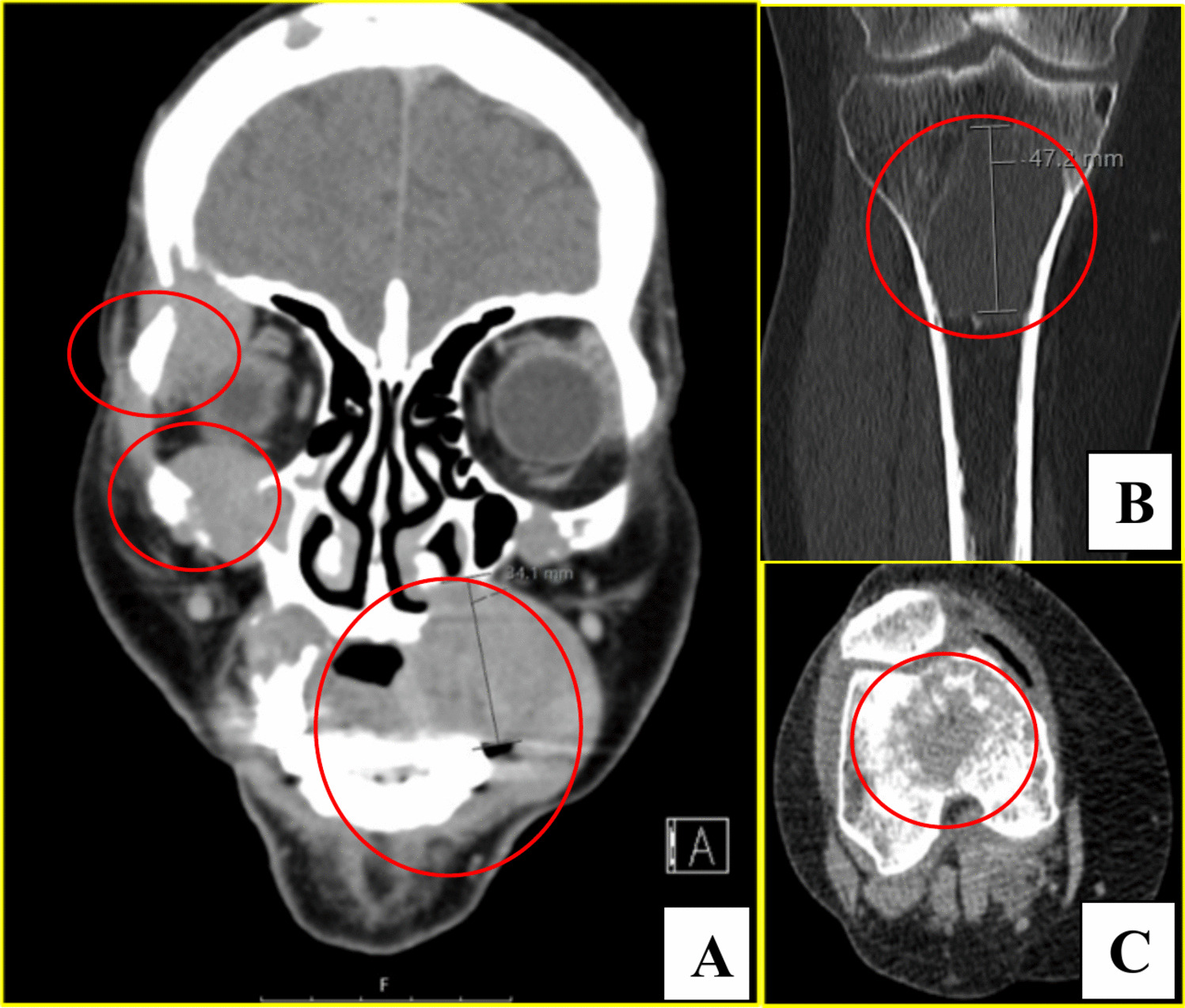 Plasmablastic plasmacytoma followed by a plasmacytic plasma cell myeloma: insights into discordant extramedullary transformation—a case report and literature review