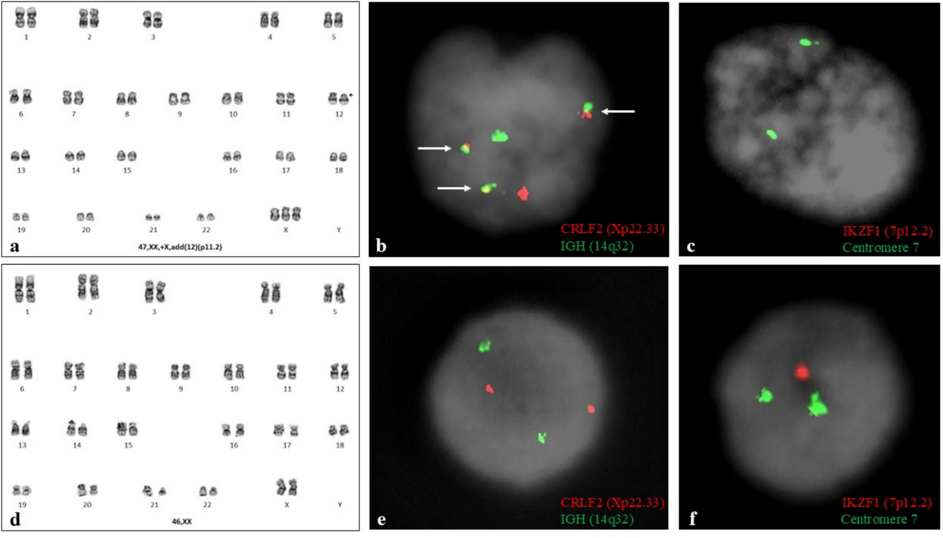 Discovery of a germline  deletion in a B-lymphoblastic leukemia post-induction bone marrow specimen: a case report and review of the literature