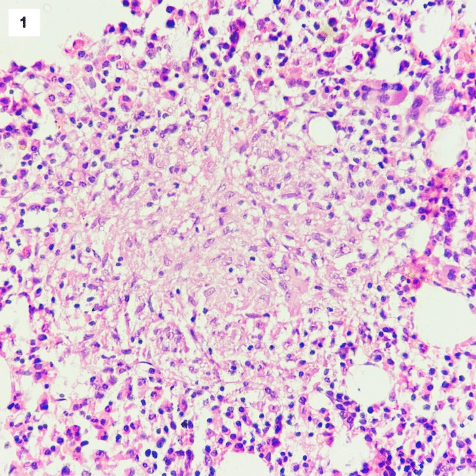 Granulomas in bone marrow: is it always tuberculosis?