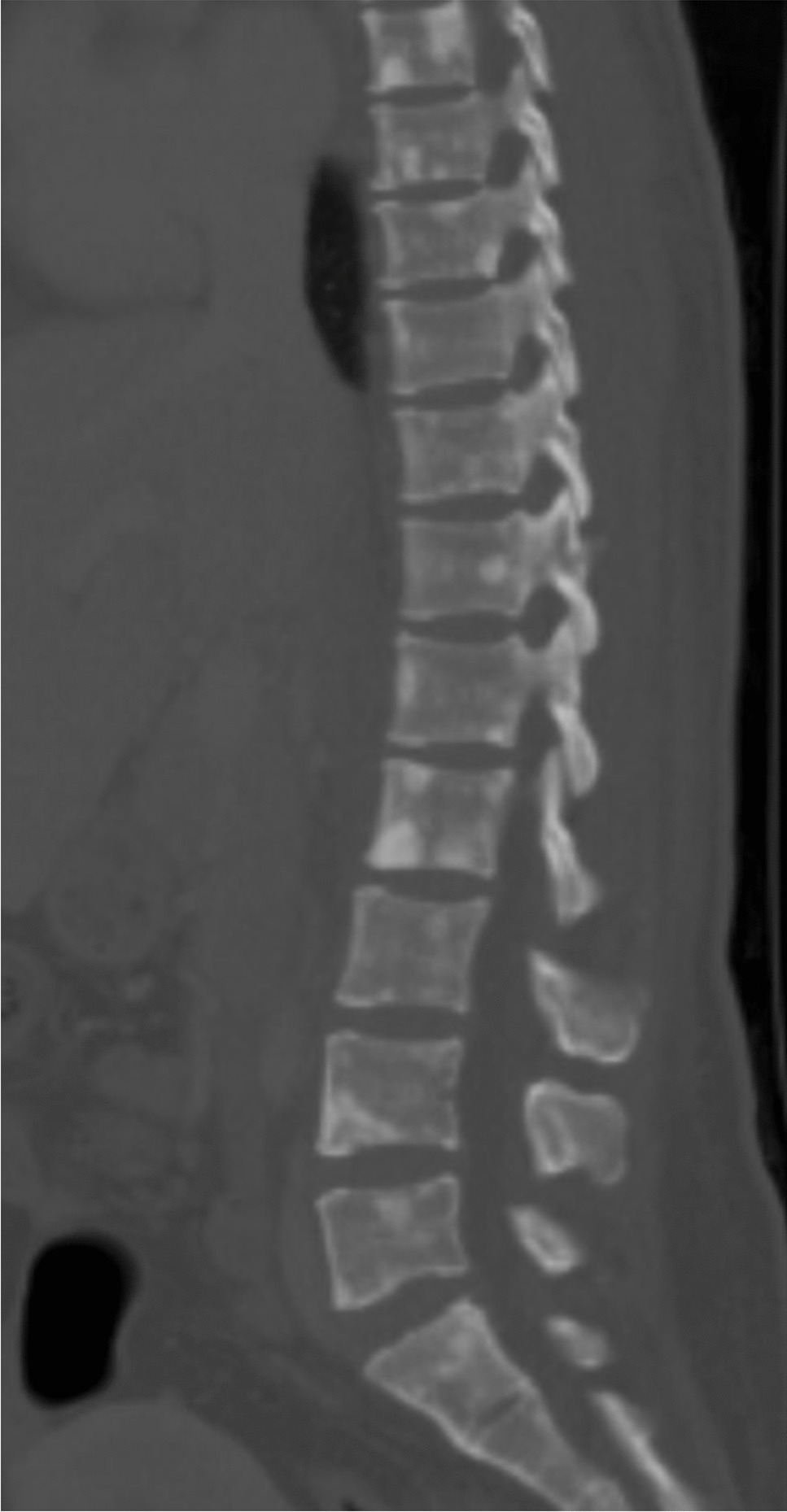 Unicentric Castleman disease following POEMS syndrome remission