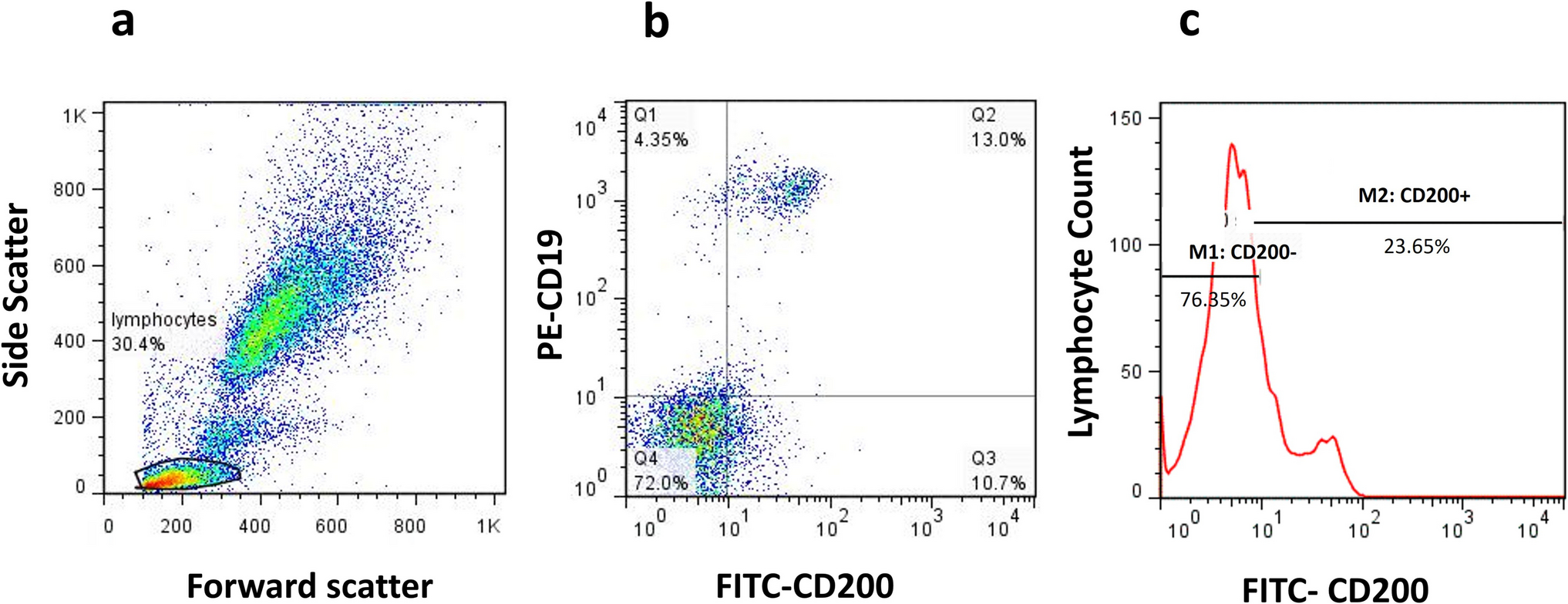 Evaluation of CD200 marker variations and its correlation with clinicopathological features of chronic lymphocytic leukemia patients: a case–control study
