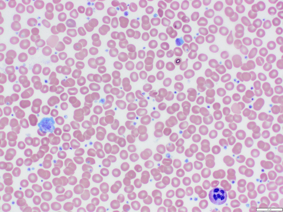 Primary myelofibrosis with concurrent  and atypical  mutations