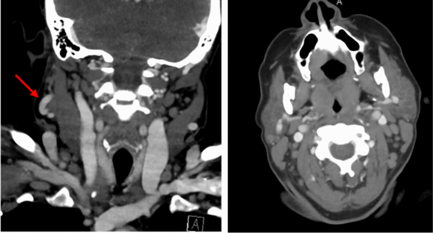 A rare case of B-cell acute lymphoblastic leukemia with translocation (14;14)(q11.2;q32) involving  and  with review of the literature
