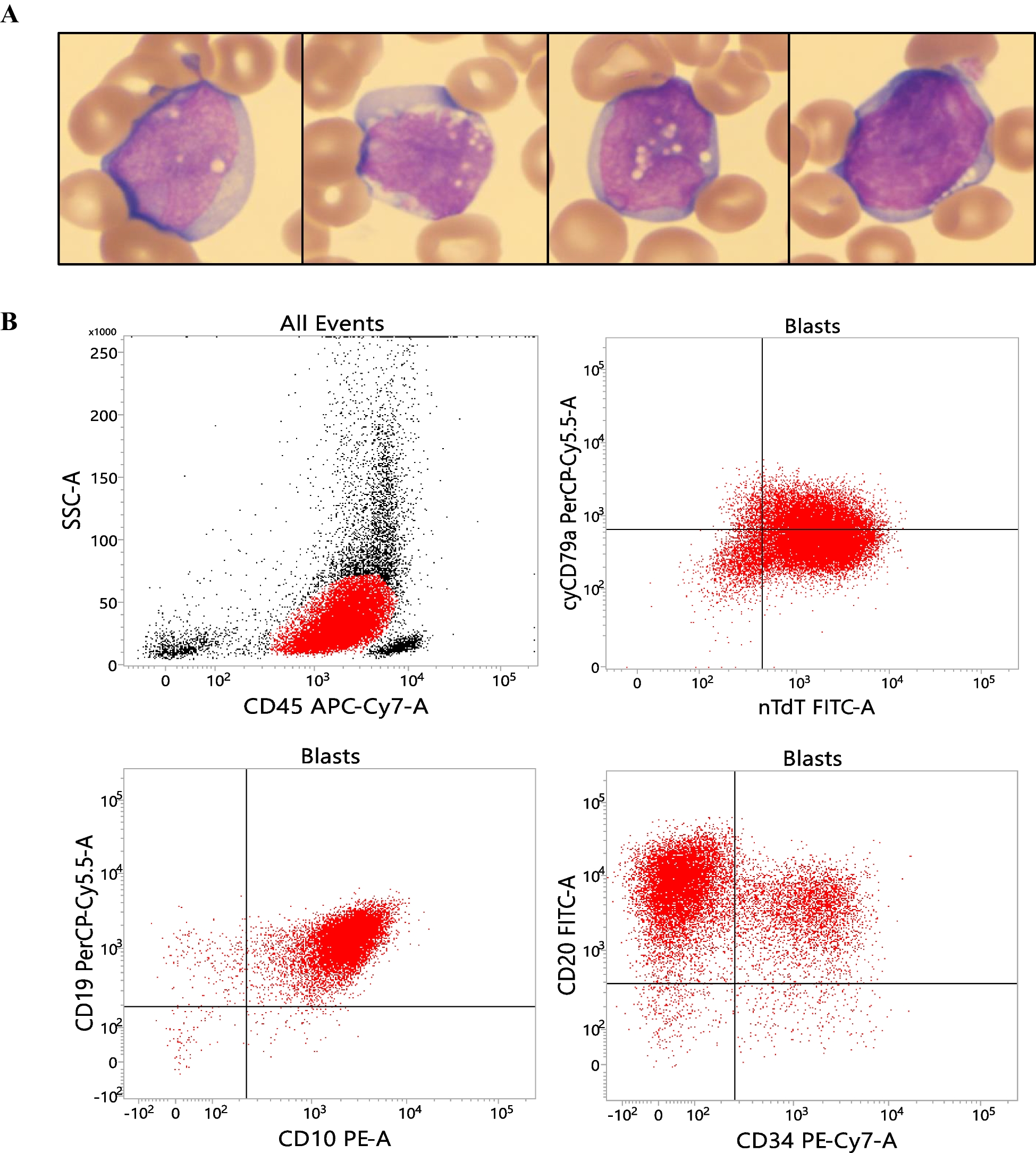 Reed-Sternberg cell-like morphologic variant of B-lymphoblastic leukemia