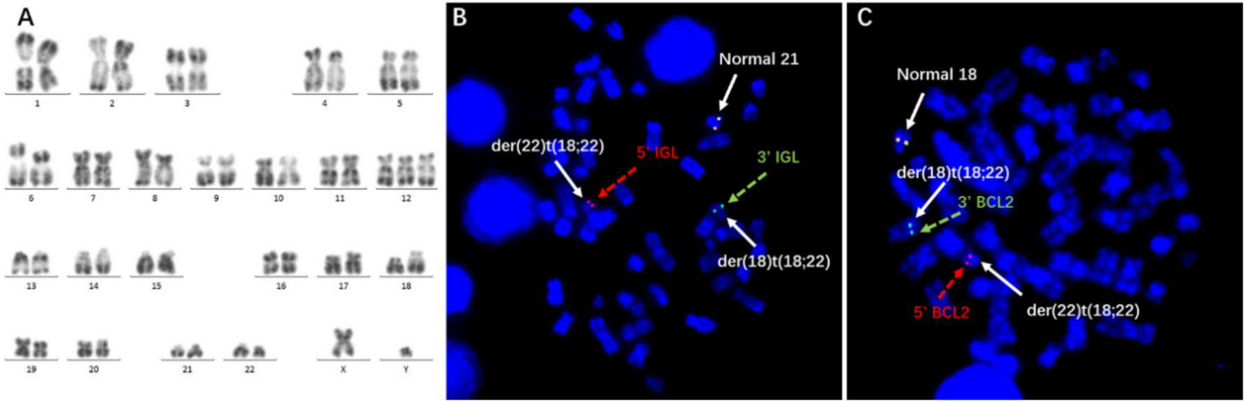 The t(18;22)/:: translocation defines a unique CLL subtype: association with early treatment initiation