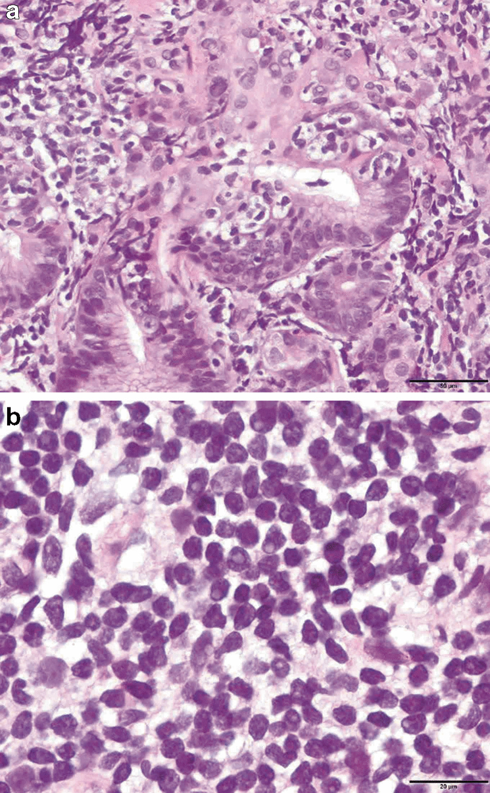 Nucleolated cells in extranodal marginal zone lymphoma: a case report and discussion of circulating lymphoma cells with prominent nucleoli