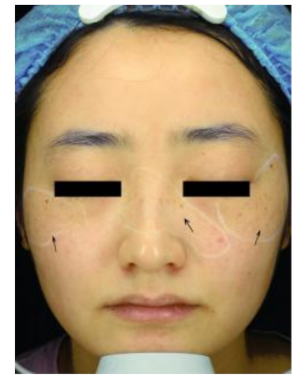 730-nm, 532-nm and 694-nm laser in the treatment of freckles and solar lentigines (A randomized clinical trial)