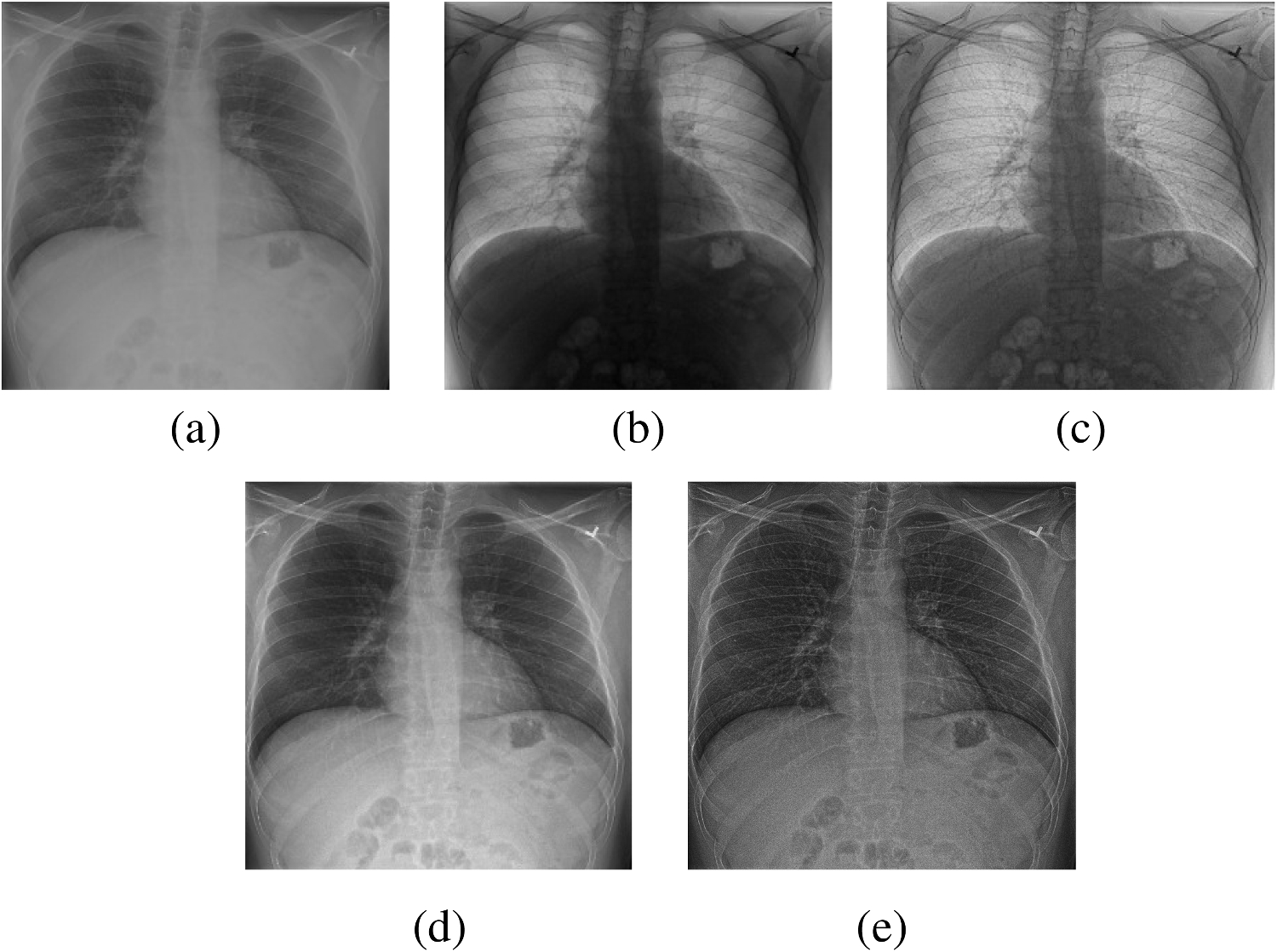 XVertNet: Unsupervised Contrast Enhancement of Vertebral Structures with Dynamic Self-Tuning Guidance and Multi-Stage Analysis