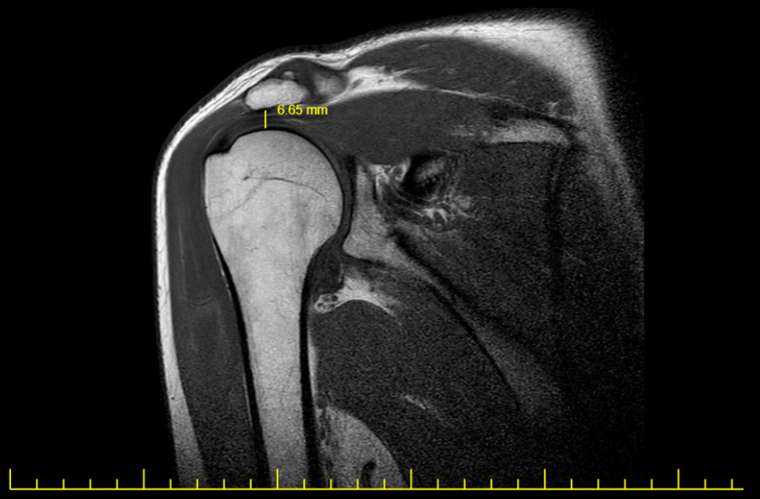 Could a New Method of Acromiohumeral Distance Measurement Emerge? Artificial Intelligence vs. Physician