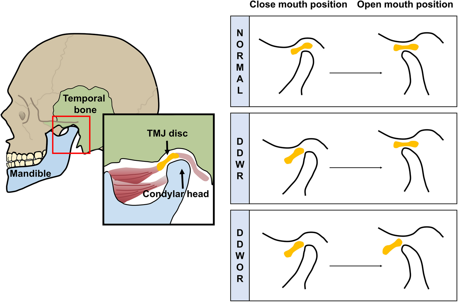 Automatic Prediction of TMJ Disc Displacement in CBCT Images Using Machine Learning