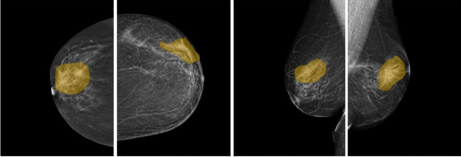 A Two-Phase Deep Learning Approach for Architectural Distortion Detection in Mammograms