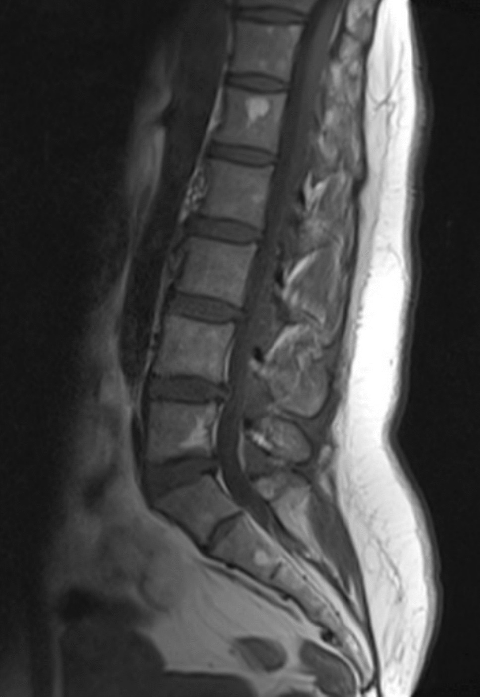Deep Learning for Osteoporosis Diagnosis Using Magnetic Resonance Images of Lumbar Vertebrae