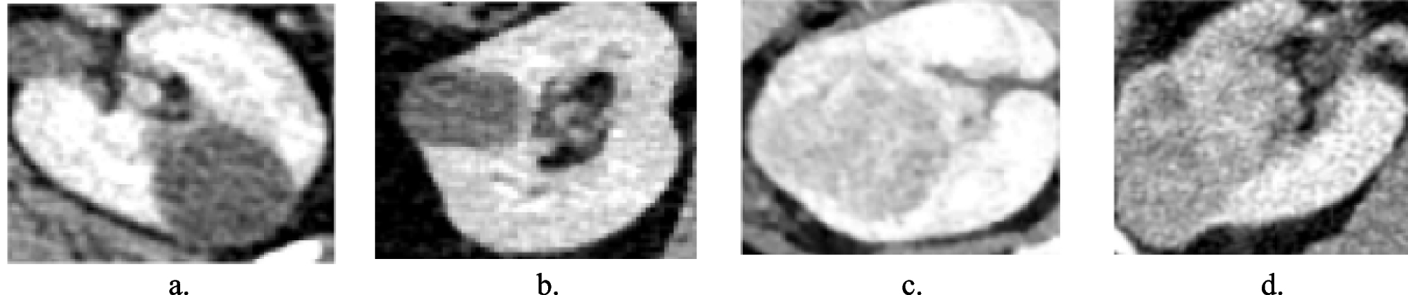 Classification of Renal Lesions by Leveraging Hybrid Features from CT Images Using Machine Learning Techniques