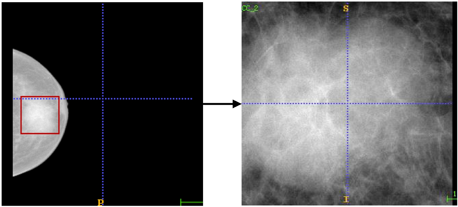 ESE and Transfer Learning for Breast Tumor Classification