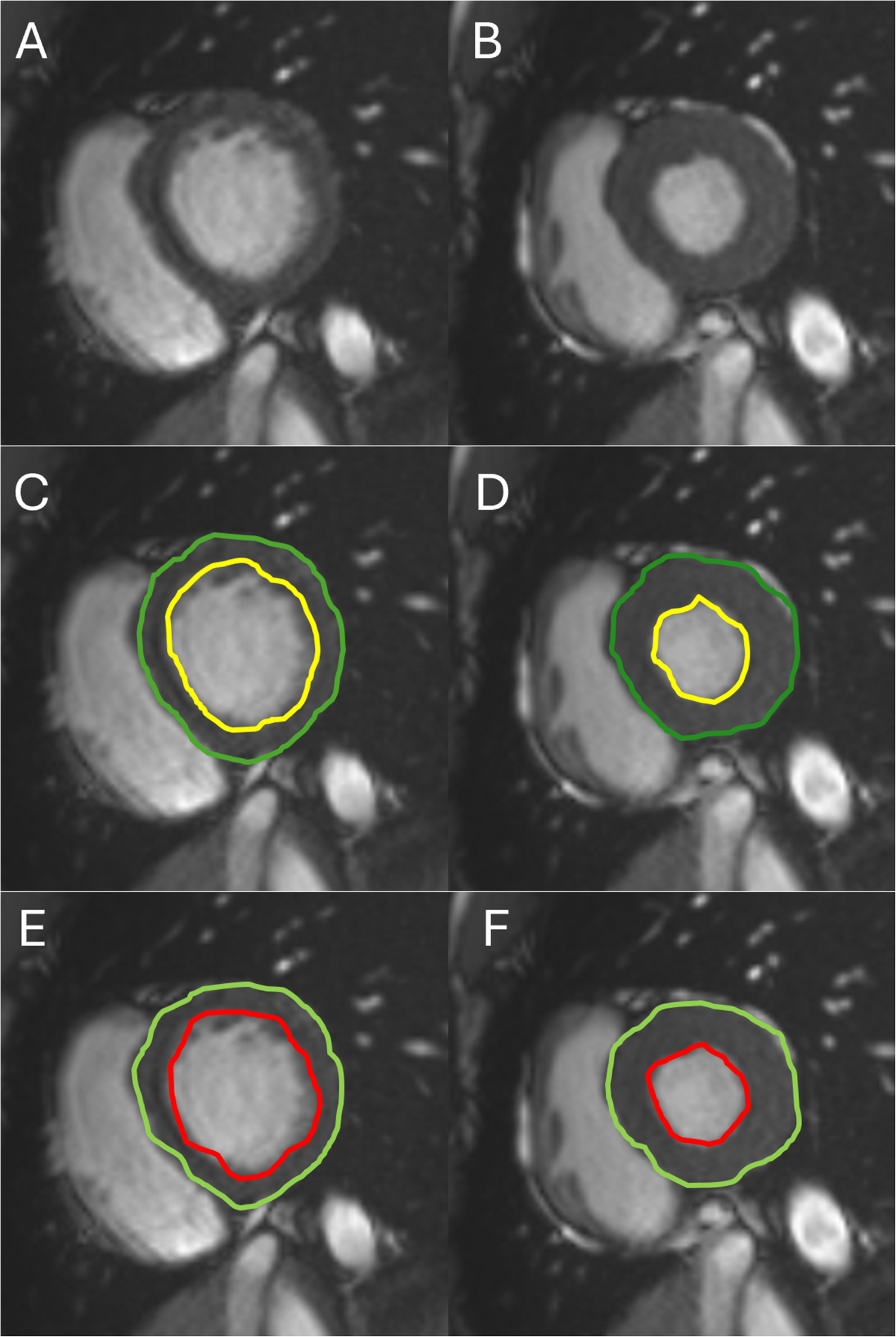 Inter-AI Agreement in Measuring Cine MRI-Derived Cardiac Function and Motion Patterns: A Pilot Study