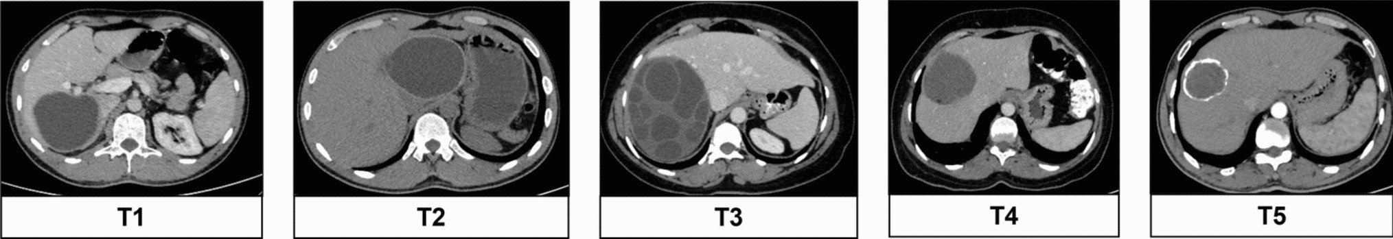 Vision Transformers-Based Deep Feature Generation Framework for Hydatid Cyst Classification in Computed Tomography Images