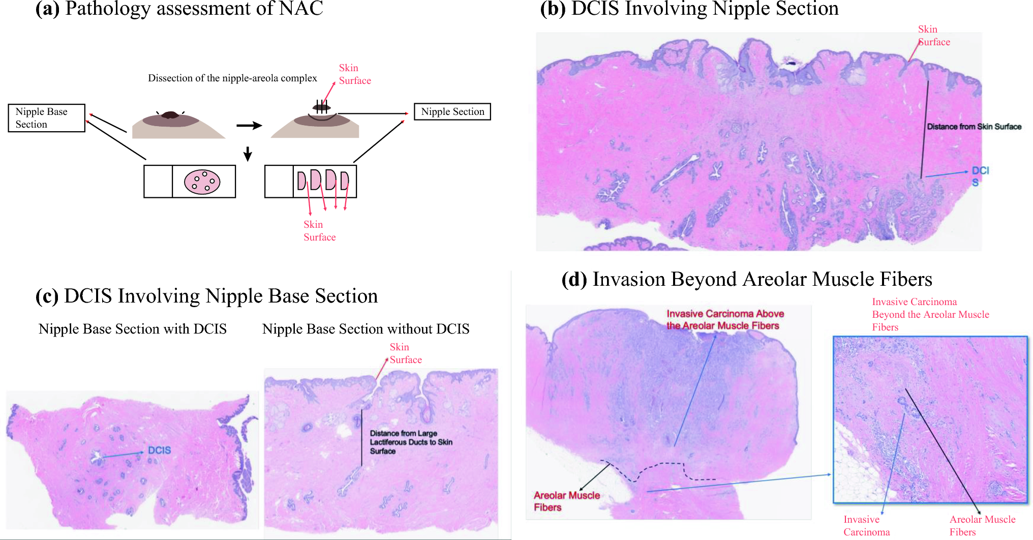 Nipple Discharge and Pathologic Involvement of the Nipple-Areolar Complex: Reconsidering Guidelines for Nipple-Sparing Mastectomy