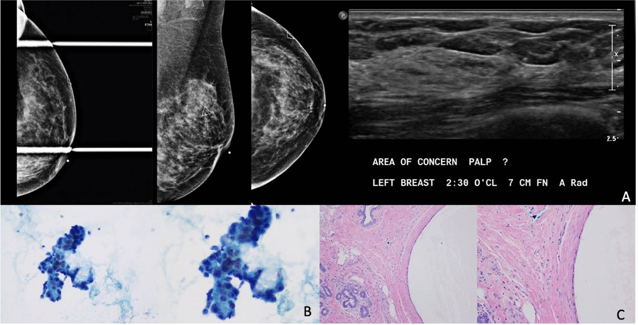 Added Value of Fine-Needle Aspiration (FNA) or Breast Magnetic Resonance Imaging (MRI) as Part of the “Triple Test” to Assess Palpable Abnormalities on a Breast Exam With Negative Imaging Findings