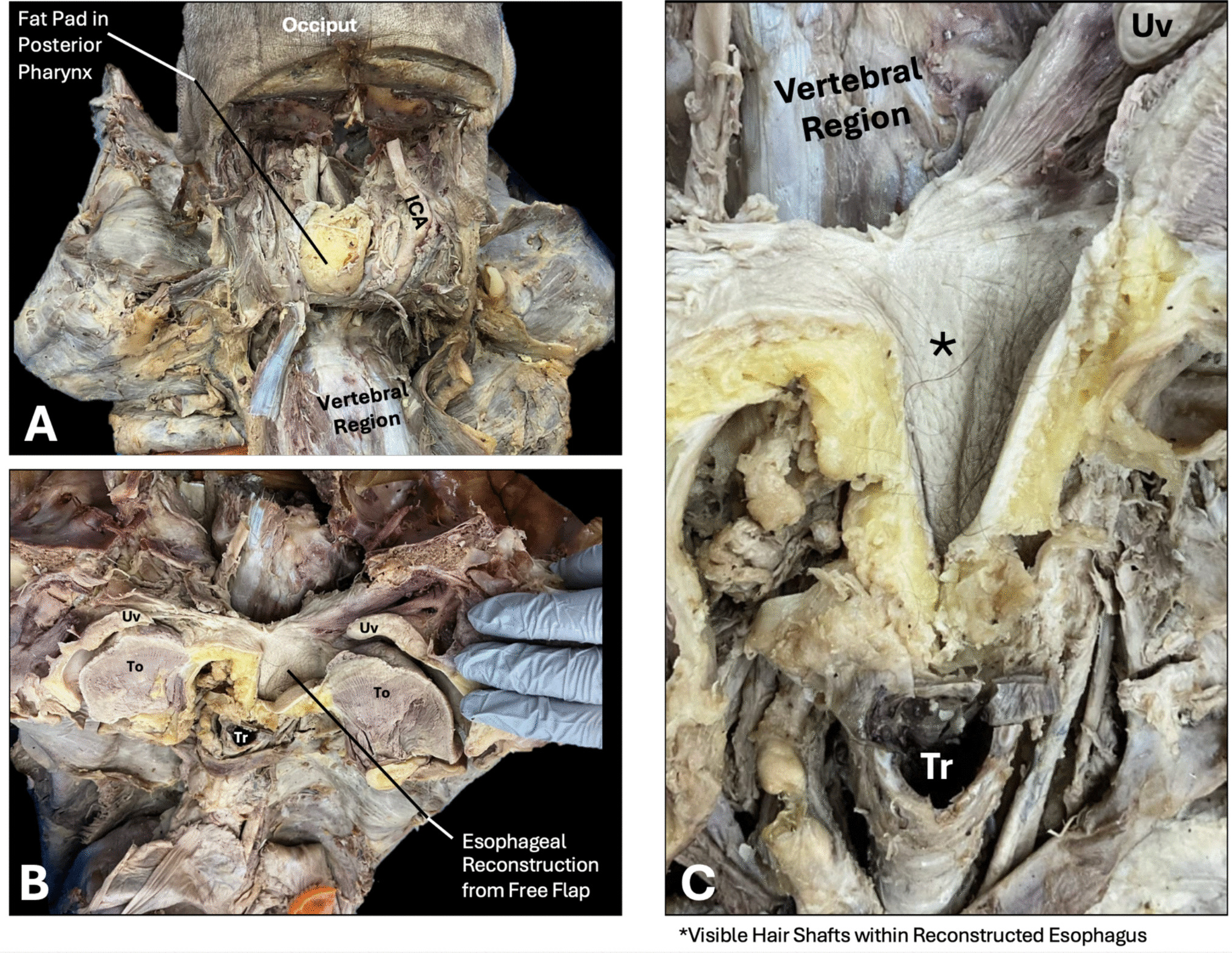 Hairy Esophagus: Incidental Finding of Esophageal Reconstruction Surgery in a Gross Anatomy Laboratory Stimulates Near-Peer Learning and Interprofessional Education