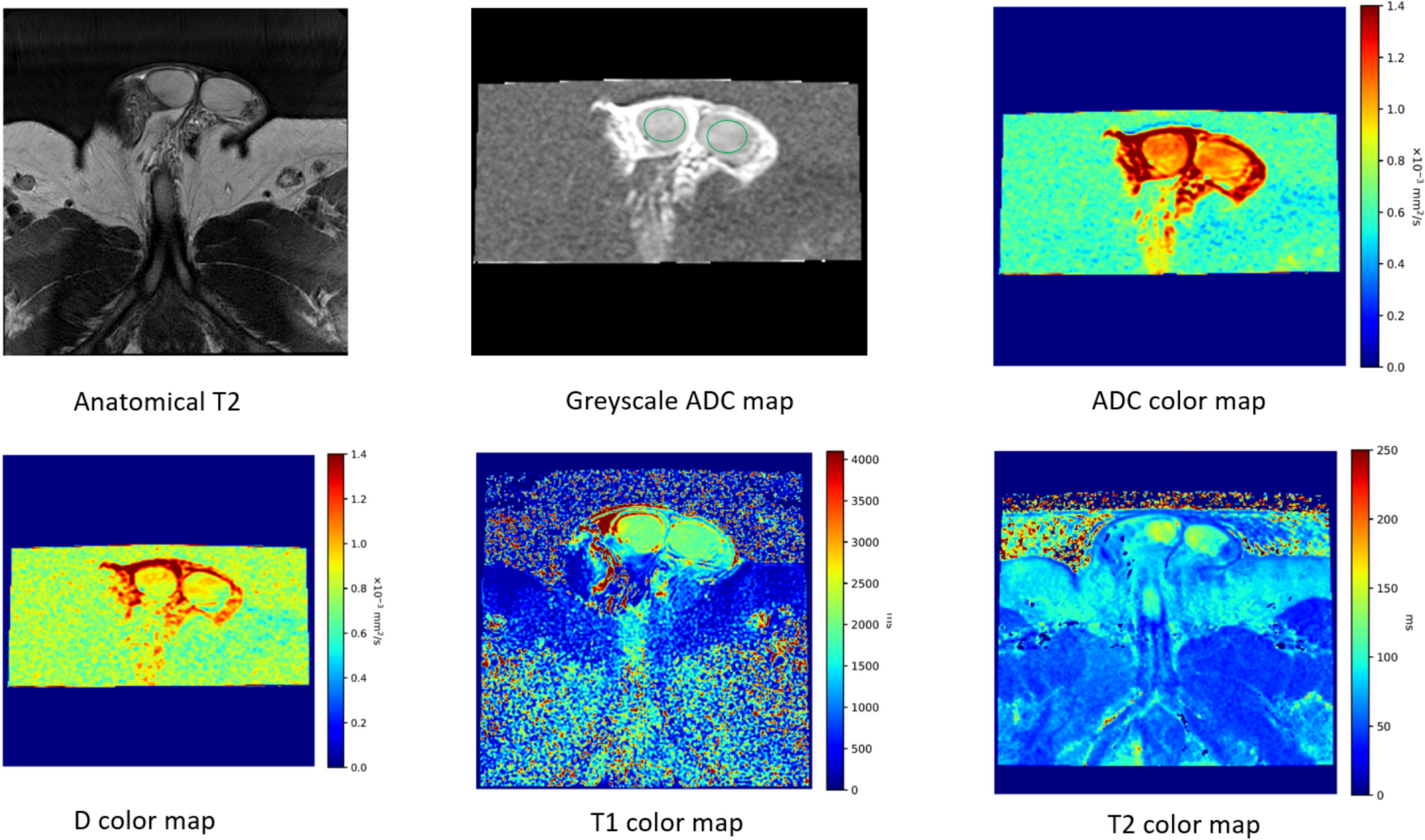 Utility of multiparametric MRI including T1/T2 mapping and IVIM/diffusion imaging for the evaluation of non-obstructive azoospermia
