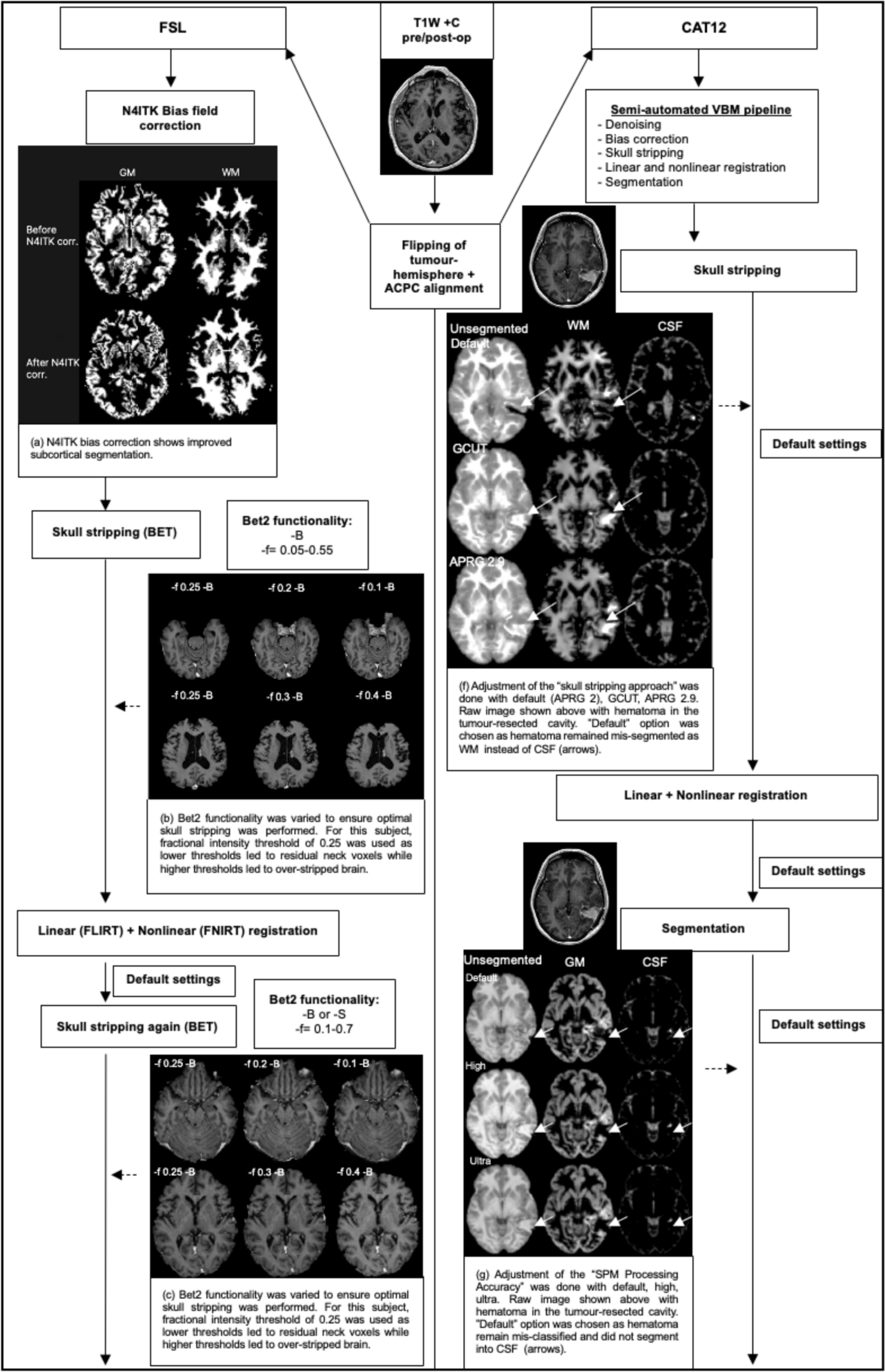 Systematic comparison of semi-automated VBM pipelines for assessing chemoradiotherapy effects on the tumoural and non-tumoural brain in glioblastoma multiforme