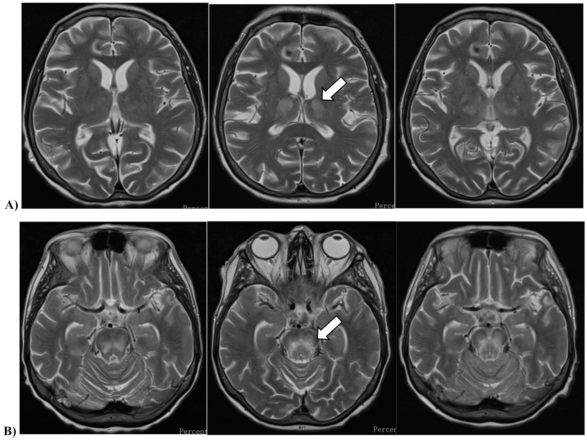 First documented case of a fatal autochthonous Usutu virus infection in an immunocompromised patient in Hungary: a clinical-virological report and implications from the literature
