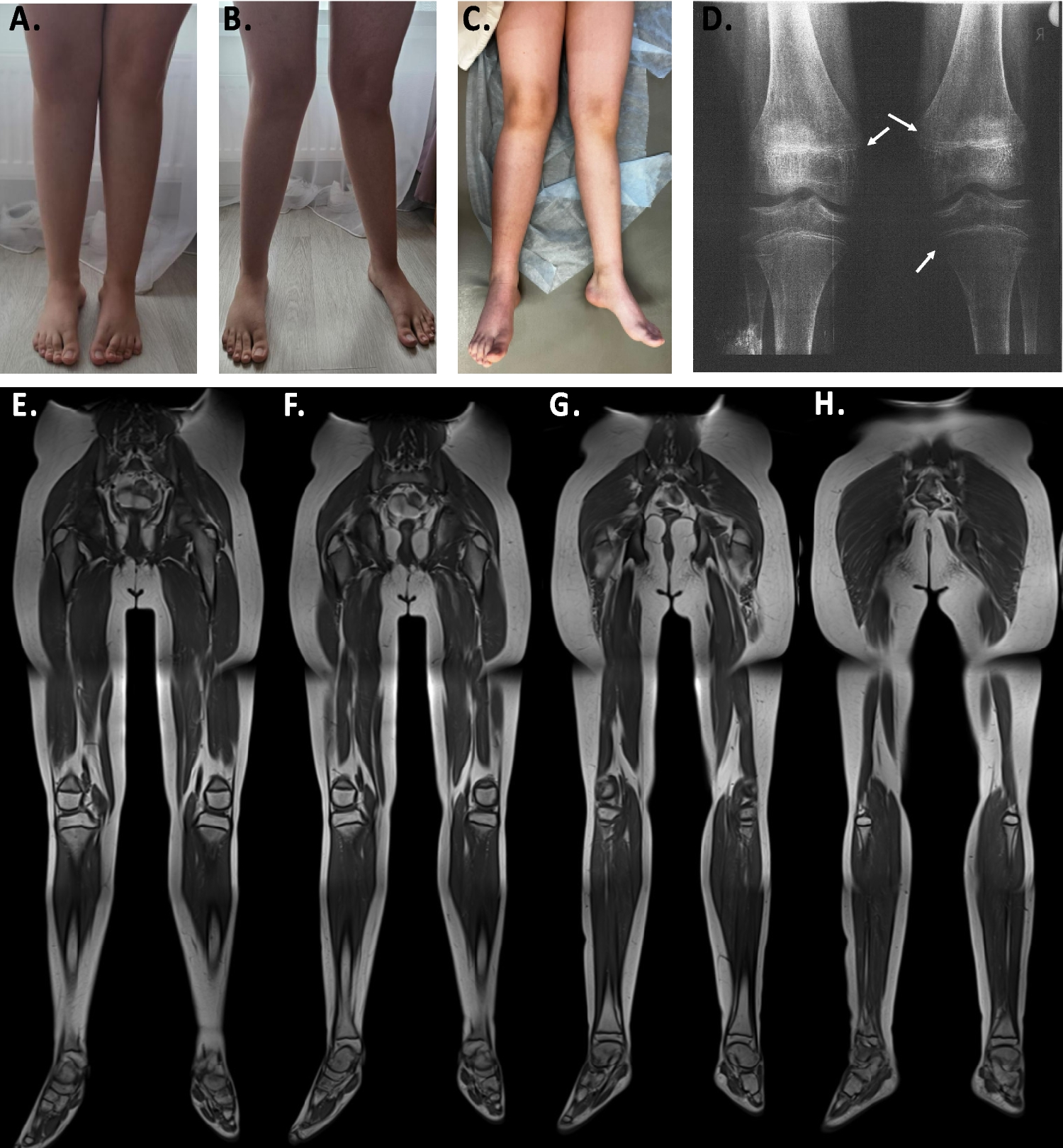 Unexpected  rickets in a case of suspected distal myopathy