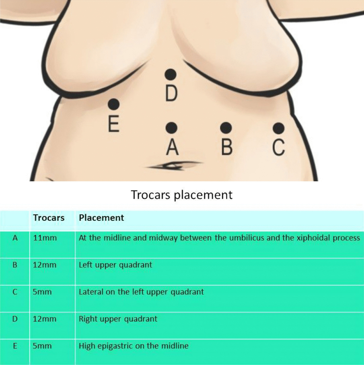 Laparoscopic Takedown of Failed Fundoplication with Recurrent Hiatal Hernia Repair and Conversion to Roux-en-Y Gastric Bypass