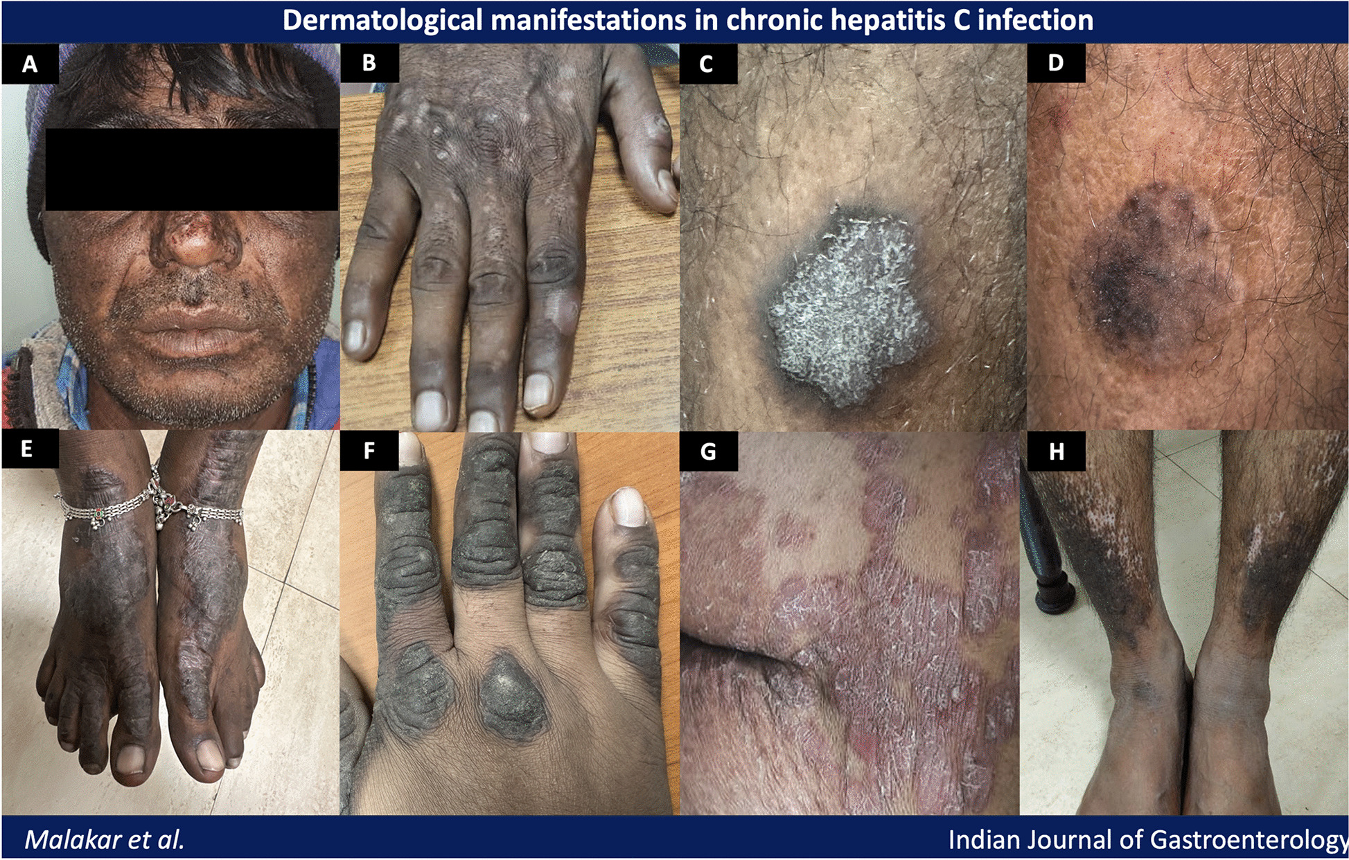 Frequency of dermatological manifestations in patients with chronic hepatitis C infections