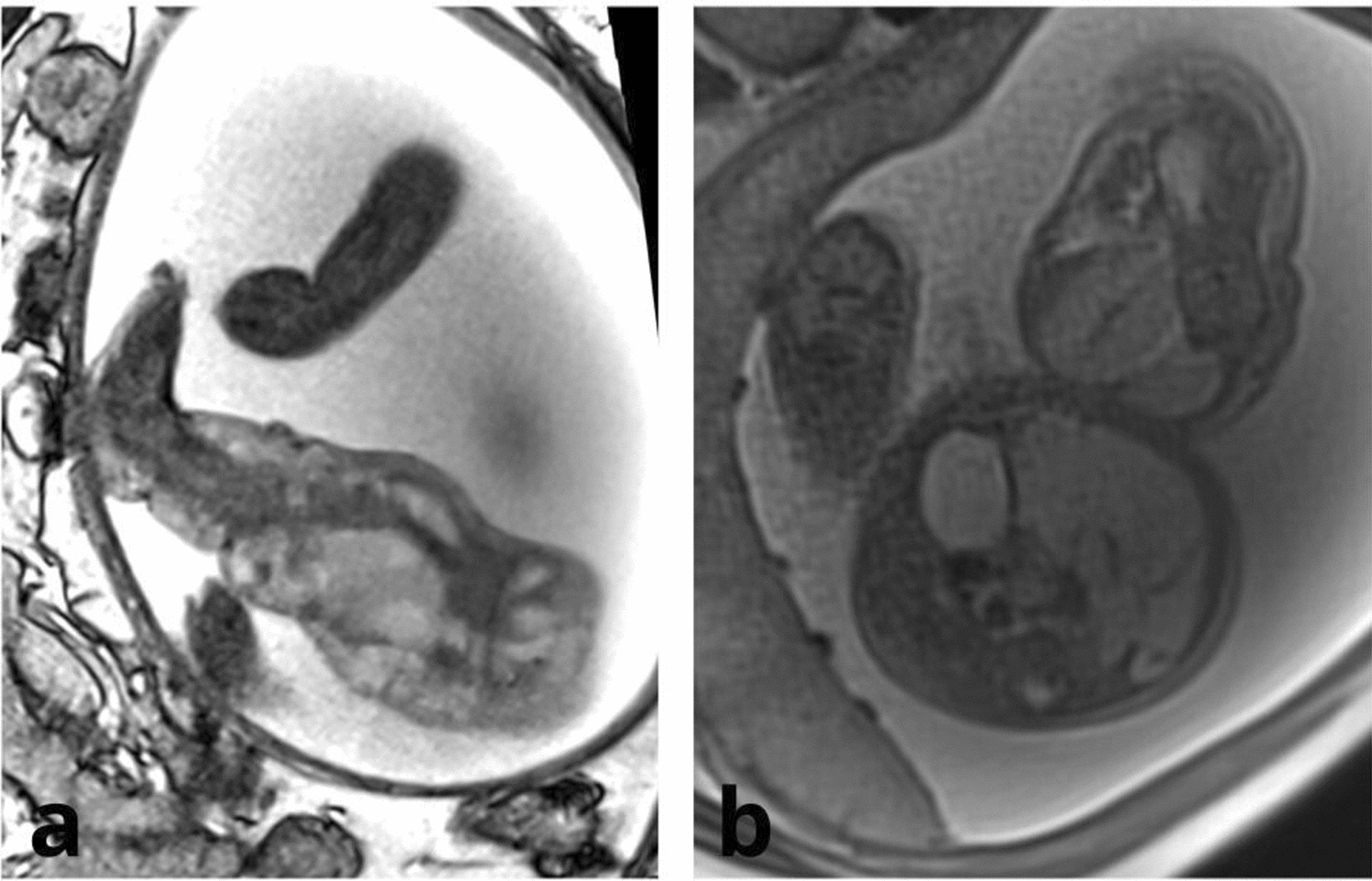 Effective Sirolimus Use in Prenatal and Postnatal Management of Symptomatic Extensive Congenital Capillary-Lymphatic-Venous Malformations (CLVMs): A Report of Two Cases