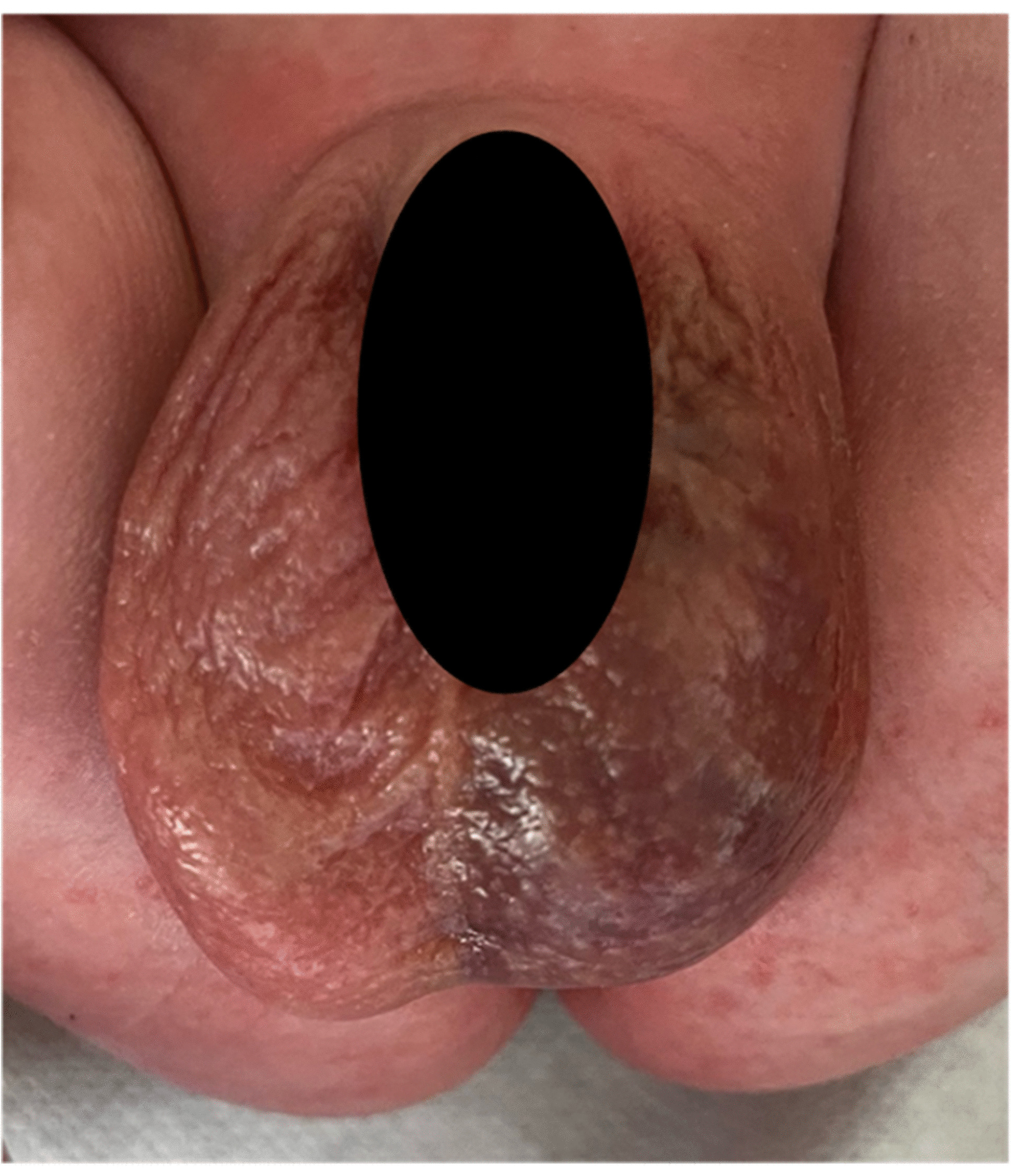 Idiopathic scrotal hematoma in newborns: a case report and literature review