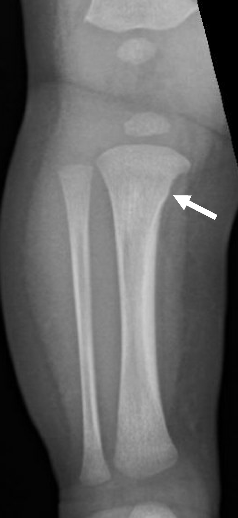 Proximal medial tibial metaphyseal bump—a normal variant