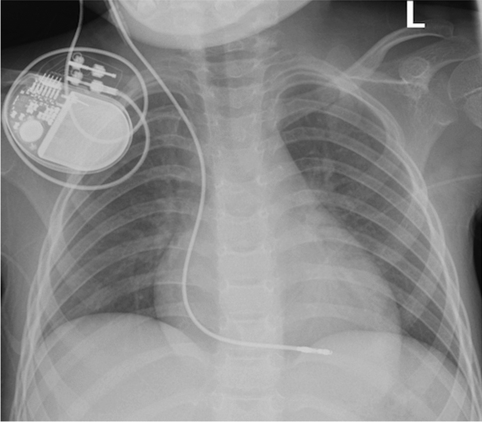 Temporary transvenous external pacing for cardiac MRI in a pediatric patient