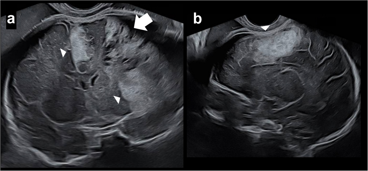 Antenatal subpial hemorrhage diagnosed by fetal magnetic resonance imaging: imaging spectrum and autopsy findings