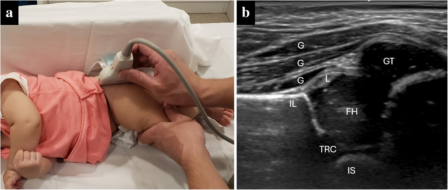Developmental dysplasia of the hip: ultrasound evaluation
