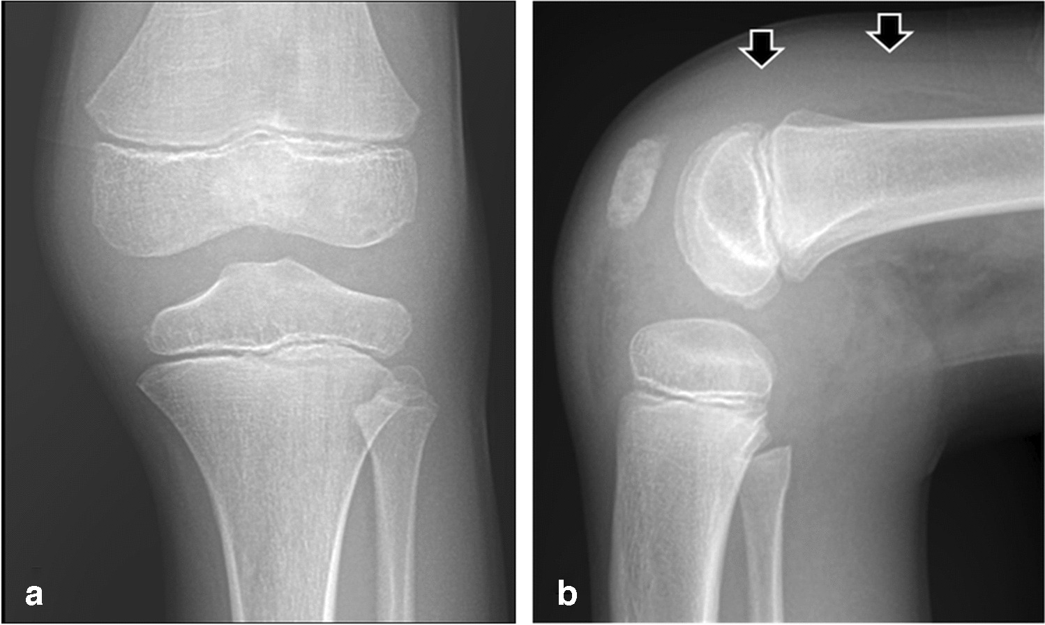 Foreign body-induced knee synovitis: importance of history by the radiologist