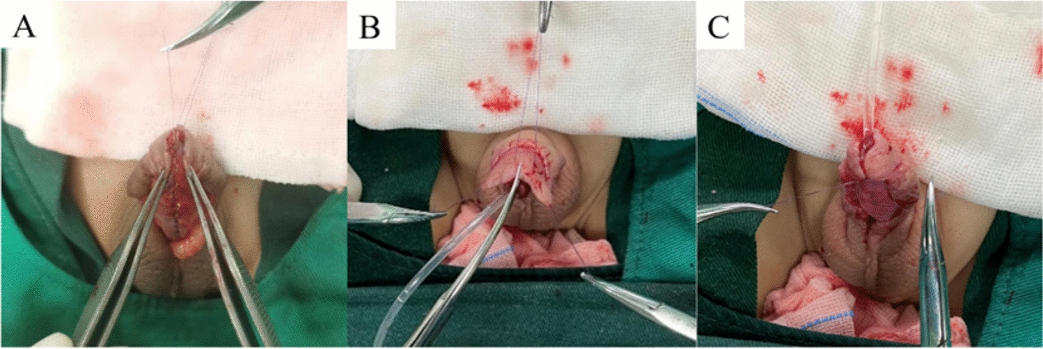 Application of glanular decompression and expansion surgery in proximal hypospadias with hypoplastic glans penis
