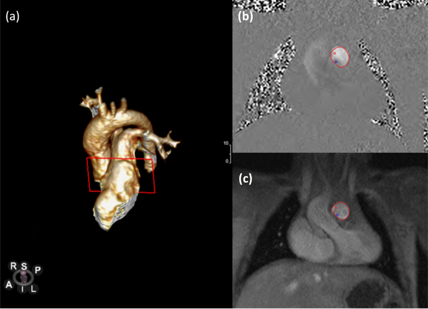 Flow Hemodynamics in Children with Tetralogy of Fallot: A Comparison Study of Cardiac Catheterization and Phase-Contrast MRI