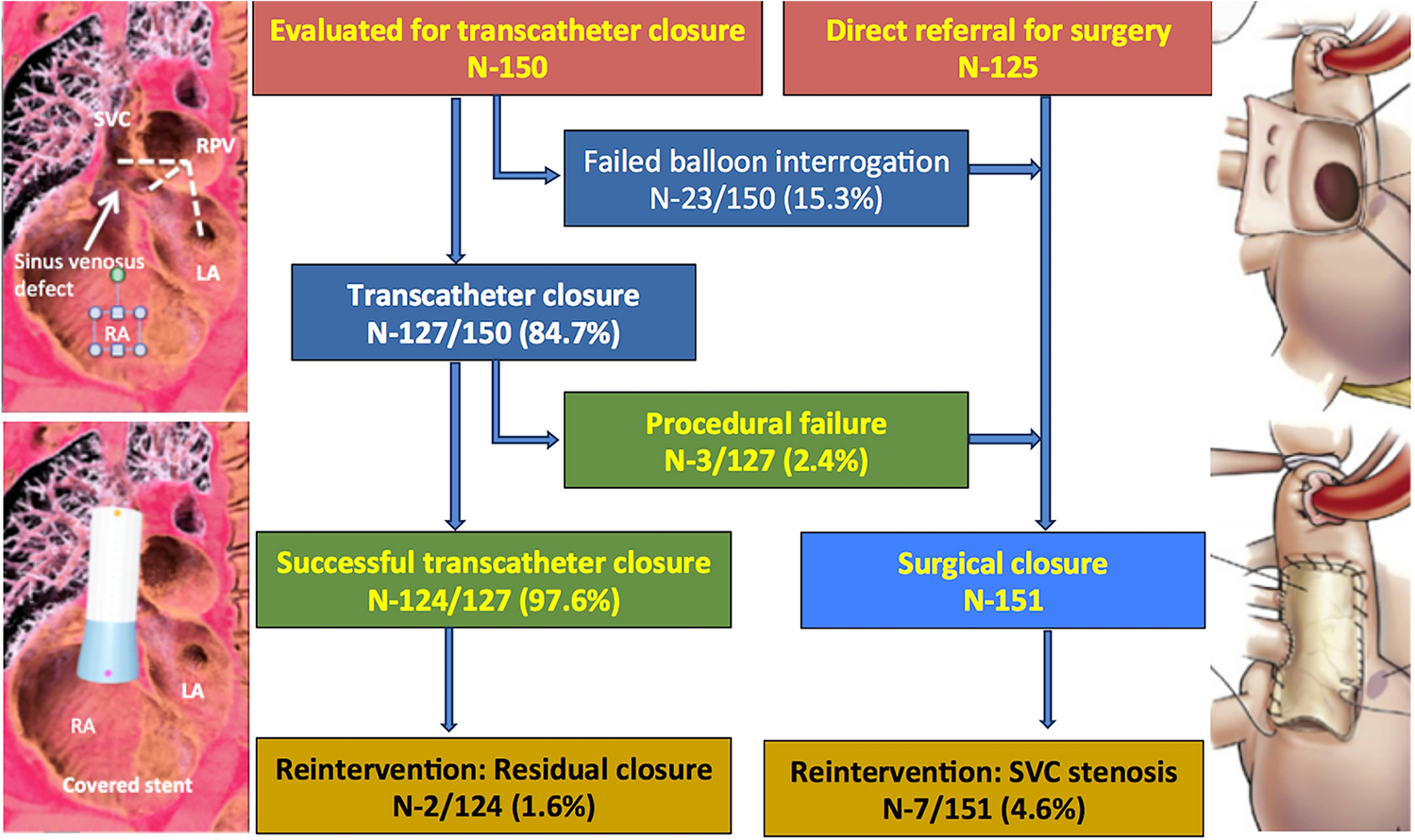 Transcatheter Versus Surgical Correction of Superior Sinus Venosus Defects: Comparison of the Outcomes and Late Complications