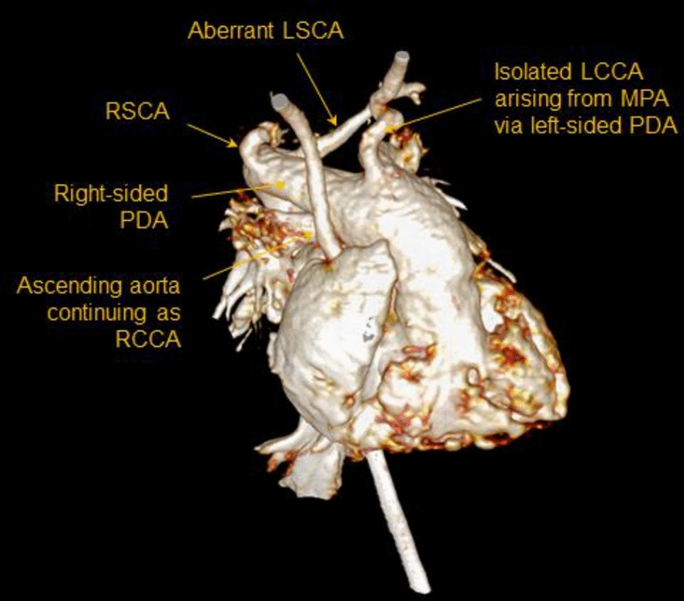 A Rare Case of Posterior Malalignment VSD with Interrupted Right Arch and Isolated Left Common Carotid Artery