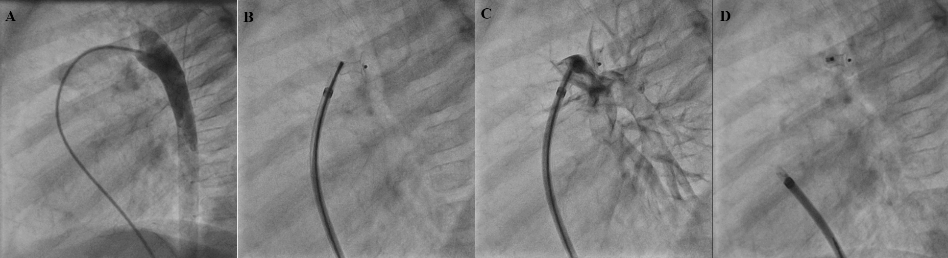 Comparative Analysis of Isolated Venous, Isolated Arterial, and Standard Access for Transcatheter Closure of Patent Ductus Arteriosus