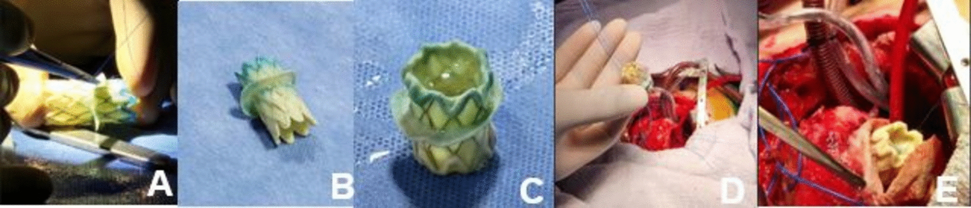 Modified Melody Valve Surgical Implantation in Atrioventricular Position in Four Children Under Two Years of Age