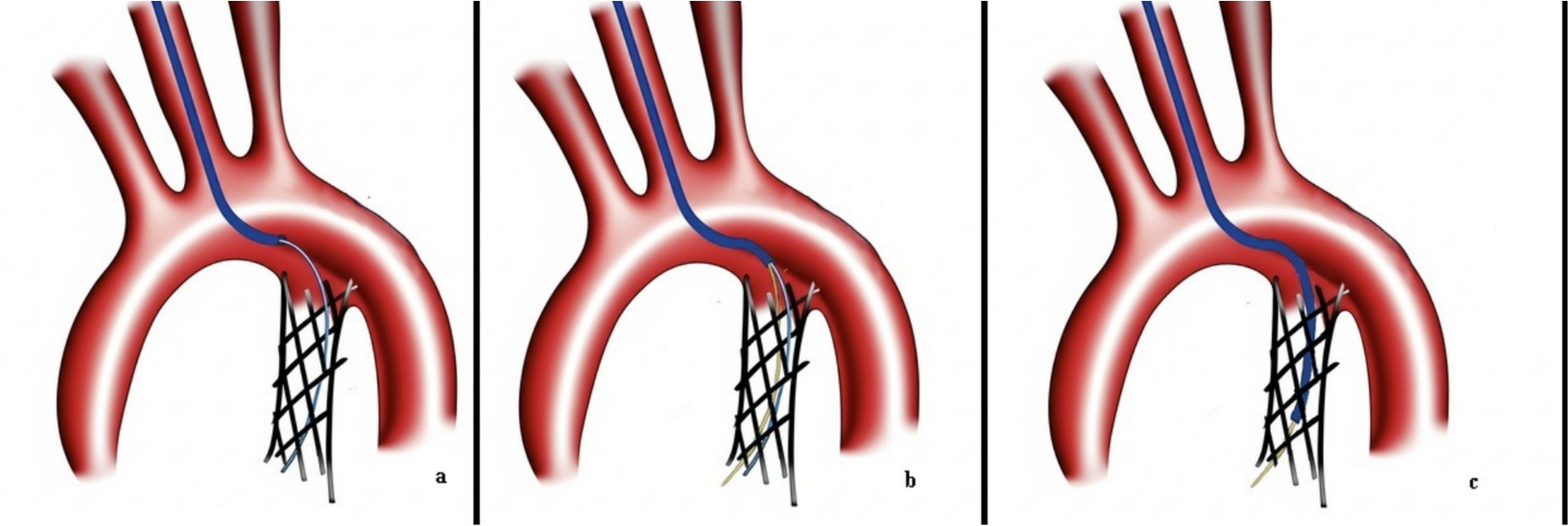 Cell-to-Lumen Wire Switch Technique for Stent Re-Access in Congenital Heart Disease: A Novel Method for Challenging Re-Interventions