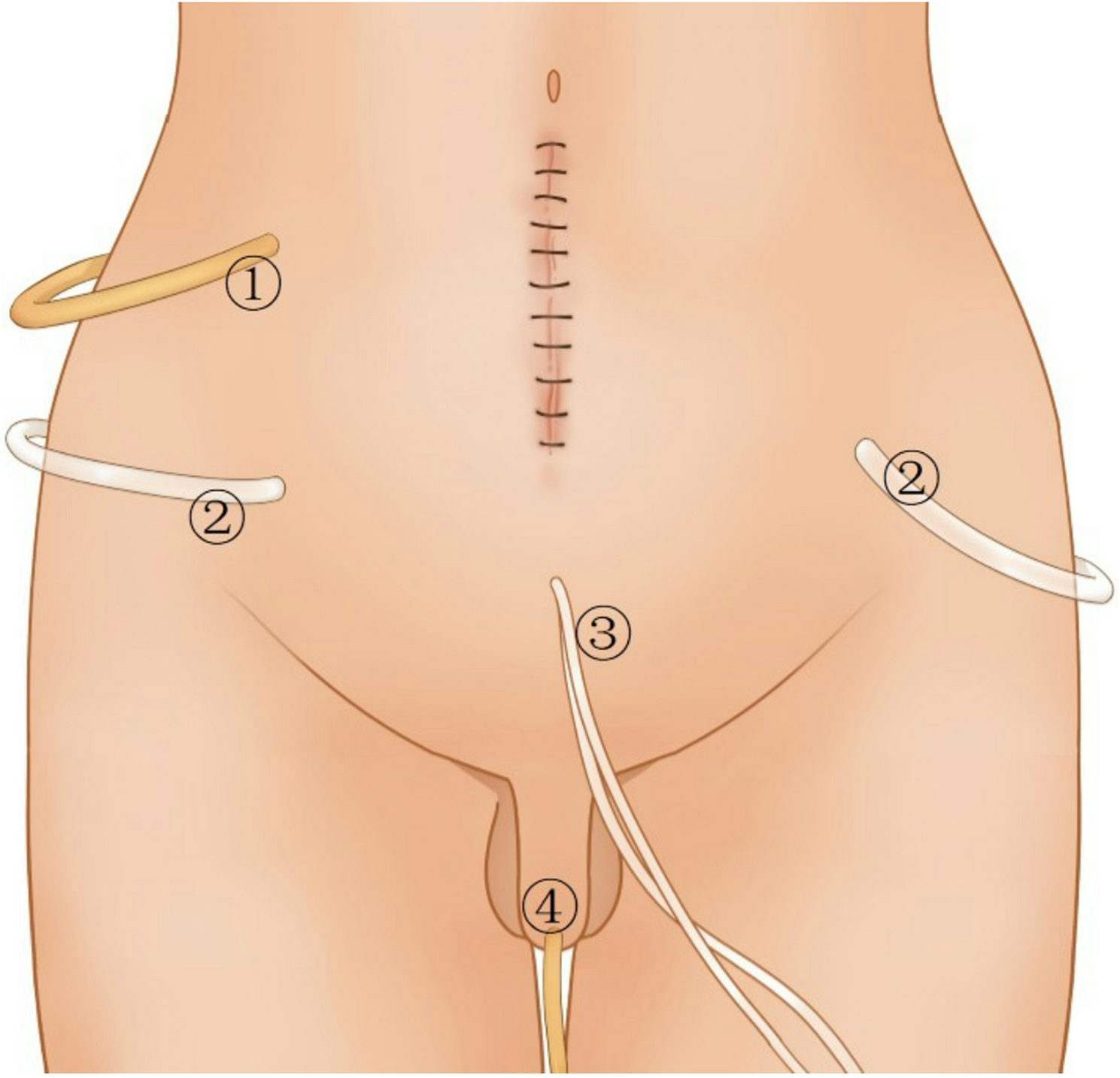 Extraperitoneal vs transperitoneal laparoscopic cystectomy: optimized surgical techniques and long-term outcomes in a single-center retrospective cohort study